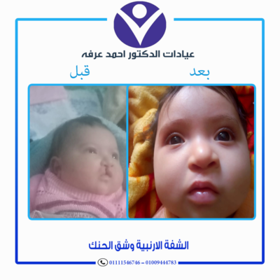 جراحة شفة أرنبية للأطفال - دكتور أحمد عرفة