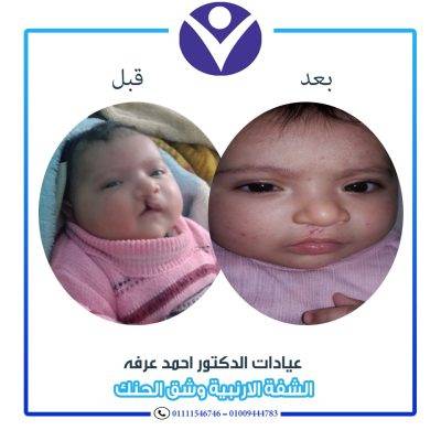 الشفة الأرنبية وشق الحنك: الأسباب، الأعراض، وطرق العلاج الحديثة