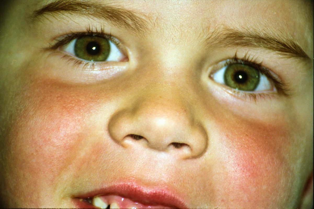 طفل يعاني من الشفة الأرنبية