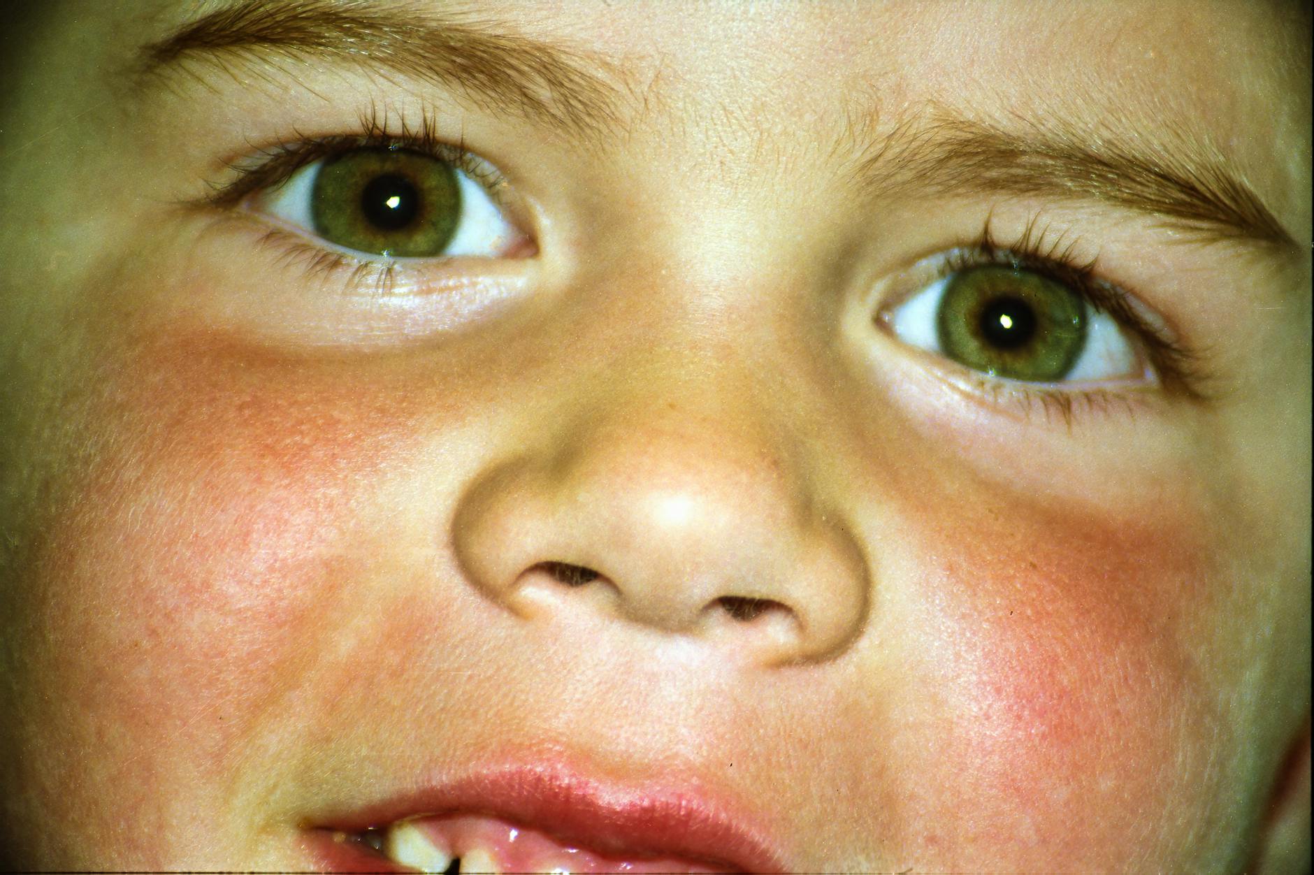 طفل يعاني من الشفة الأرنبية